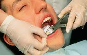 اقدامات بیمار بعد از کشیدن دندان